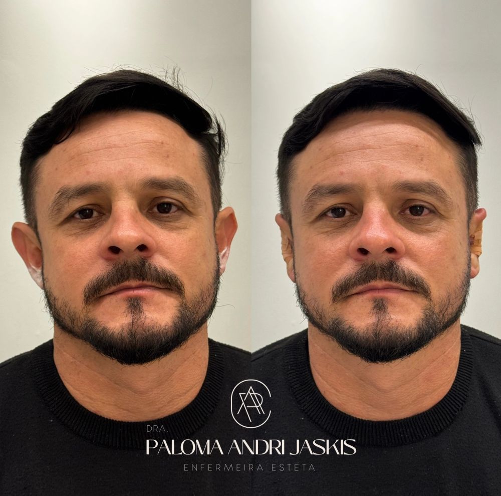 Antes e depois otomodelação — caso 1