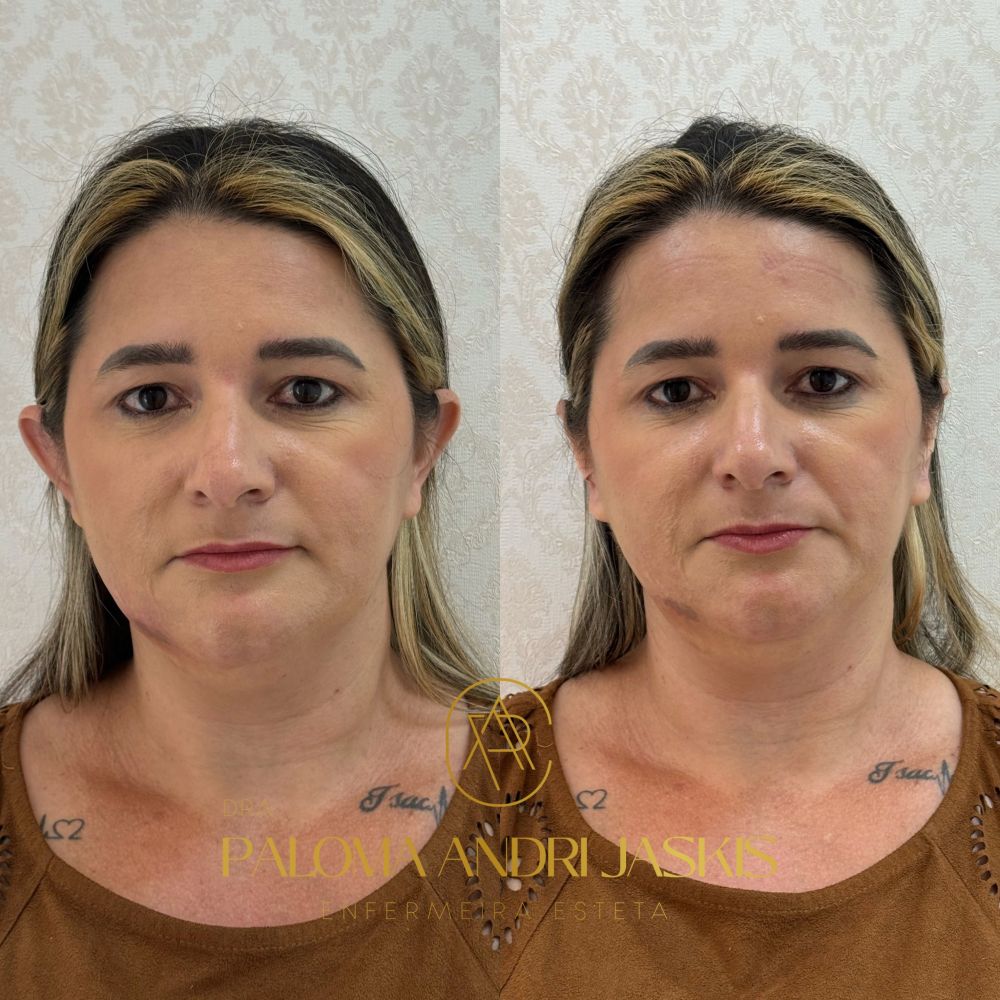 Antes e depois otomodelação — caso 2