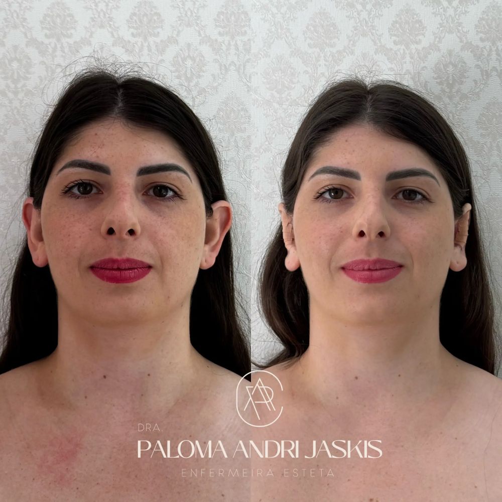 Antes e depois otomodelação — caso 3