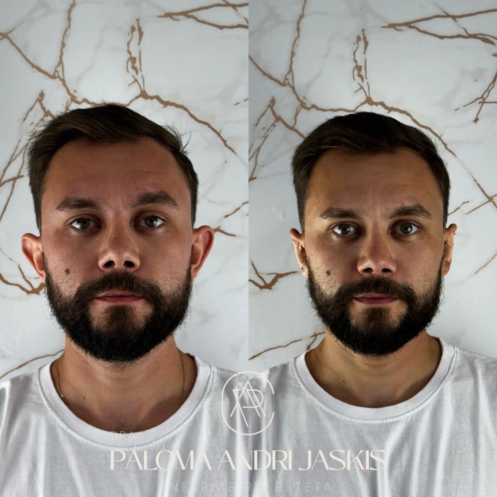 Antes e depois otomodelação — caso 4