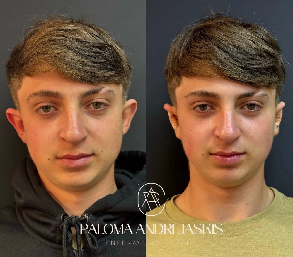 Antes e depois otomodelação — caso 5