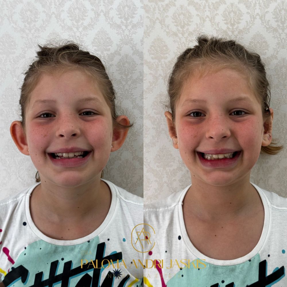 Antes e depois otomodelação — caso 6