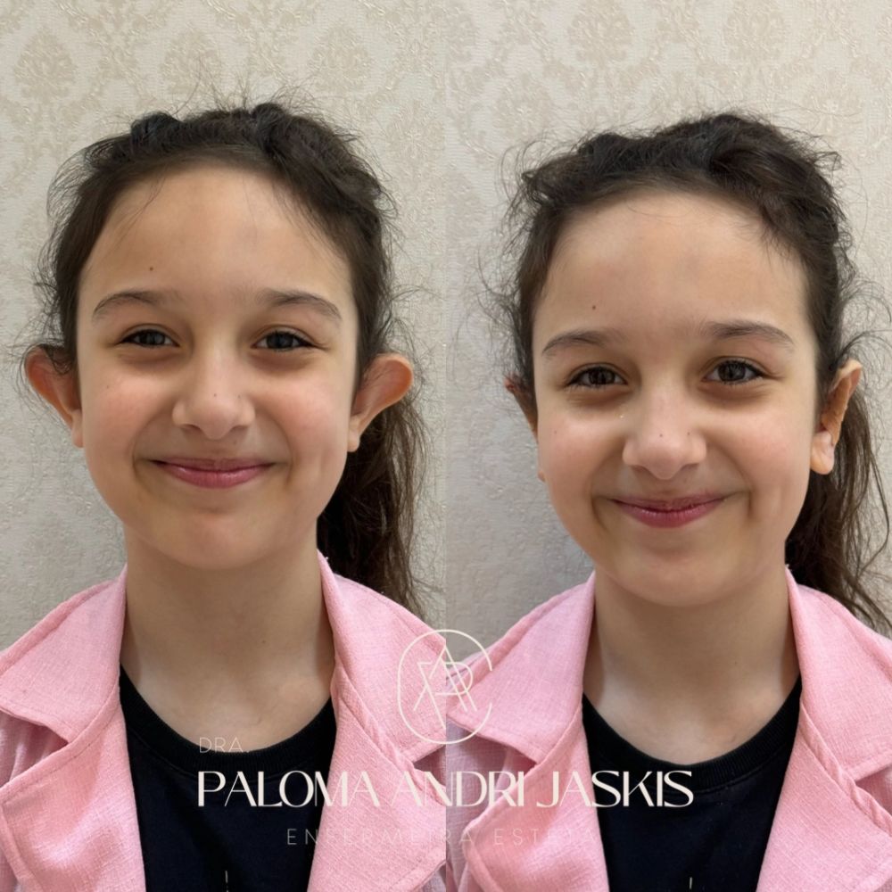 Antes e depois otomodelação — caso 7