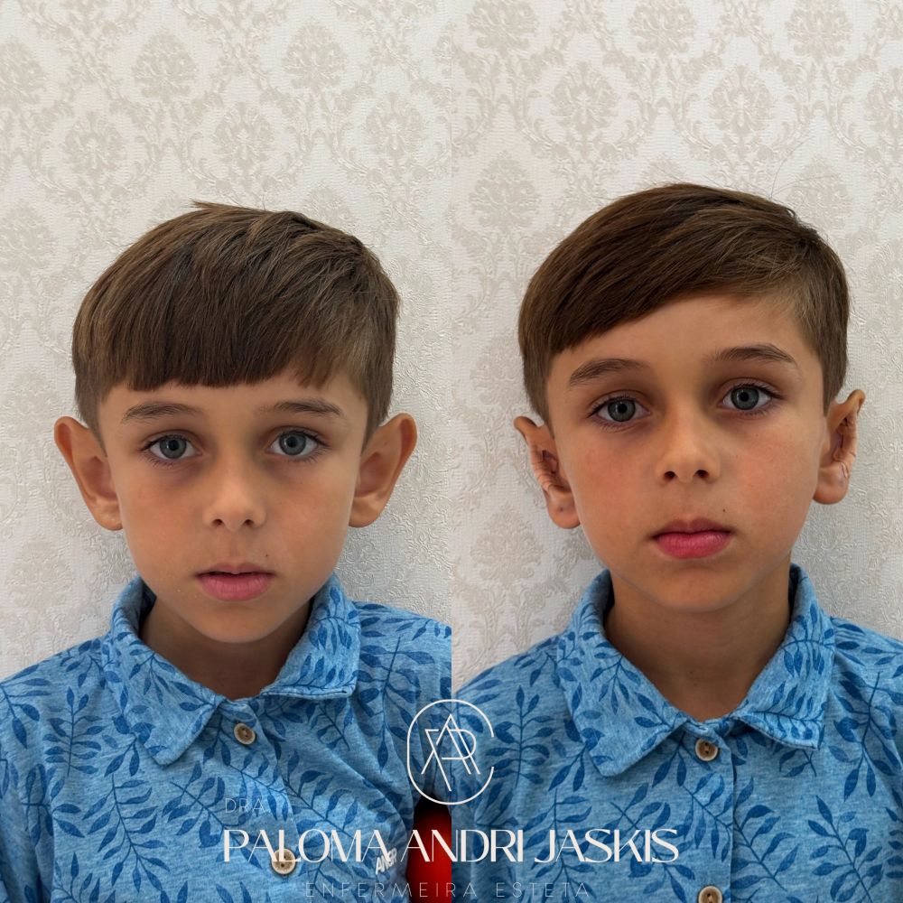 Antes e depois otomodelação — caso 9