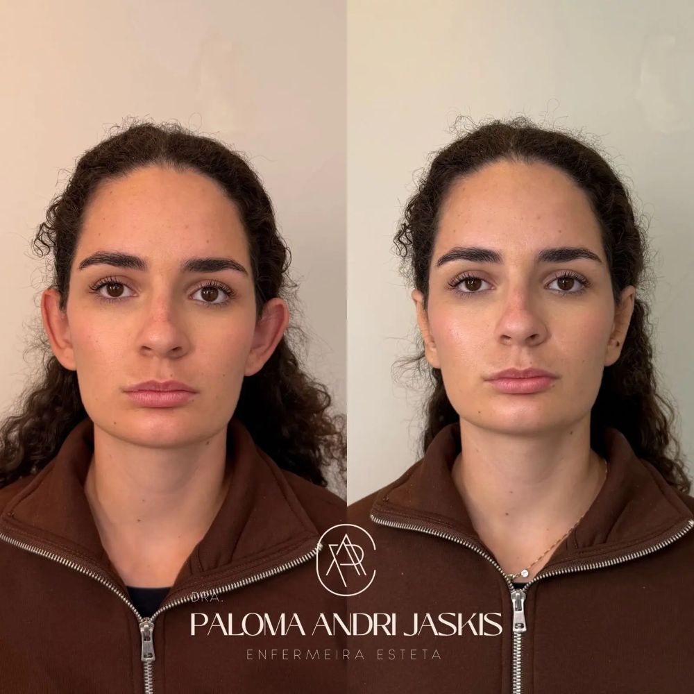 Antes e depois otomodelação — caso 10