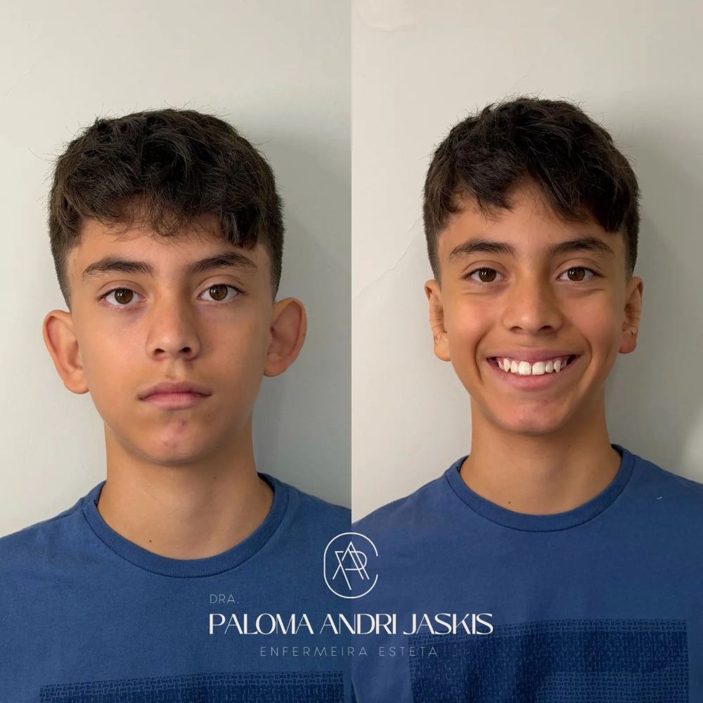 Antes e depois otomodelação — caso 11