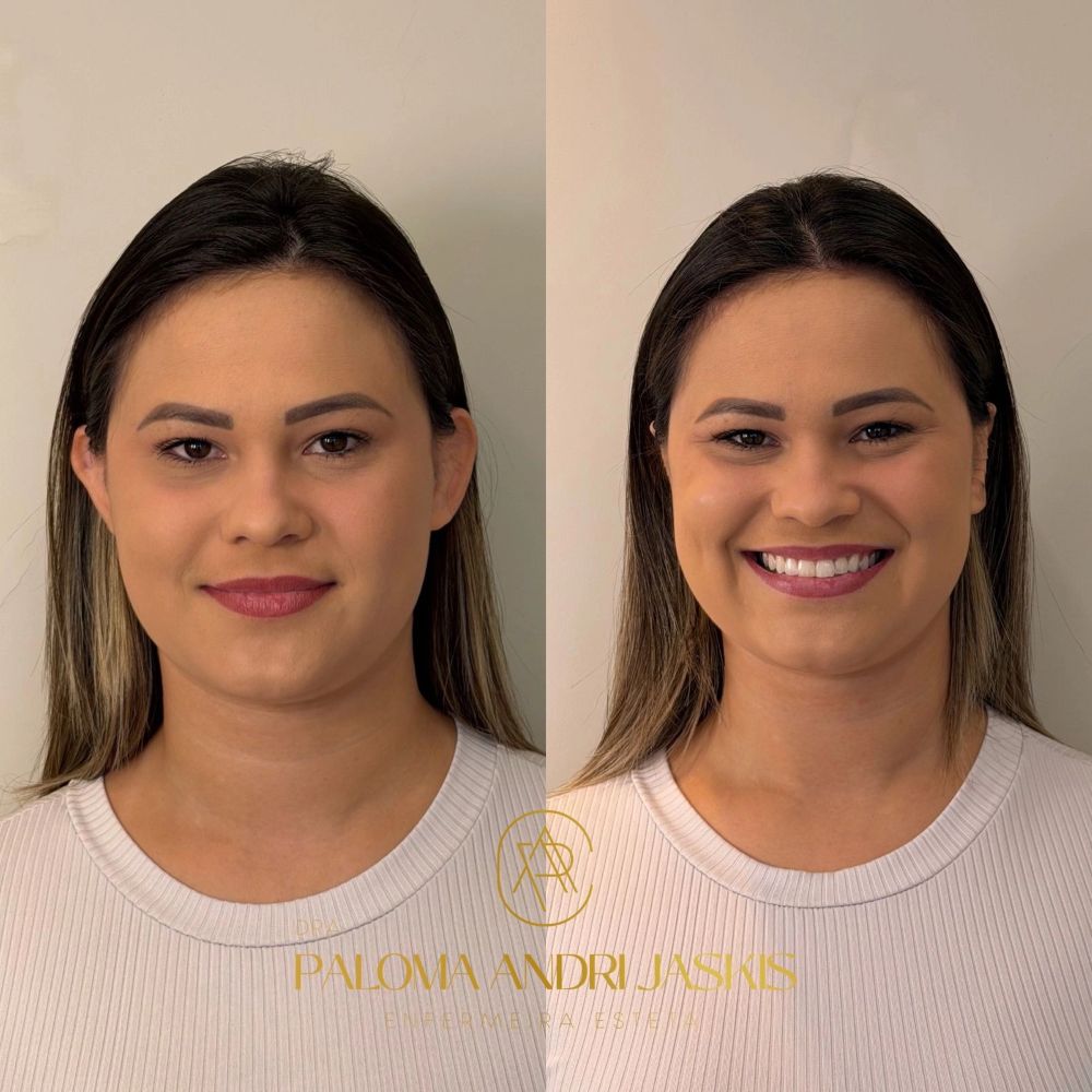 Antes e depois otomodelação — caso 12
