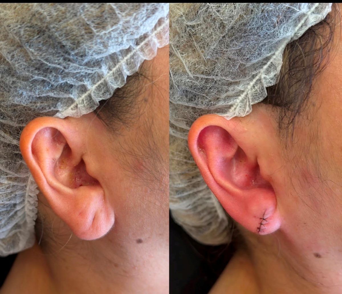 Resultado de lobuloplastia — caso 1