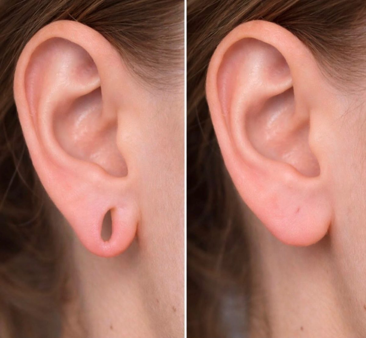 Resultado de lobuloplastia — caso 3