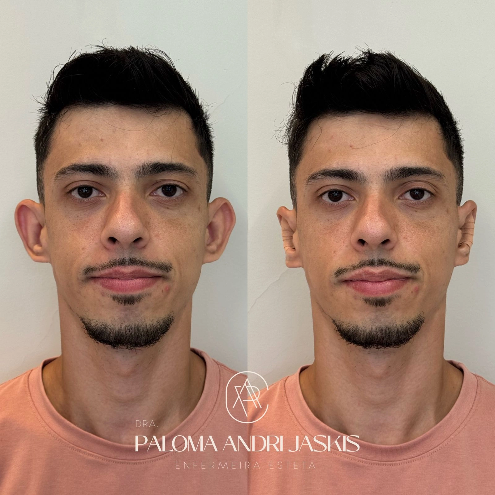 Antes e Depois 34