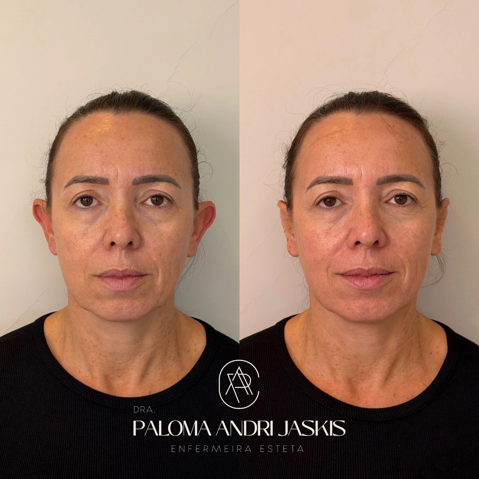 Antes e Depois 40